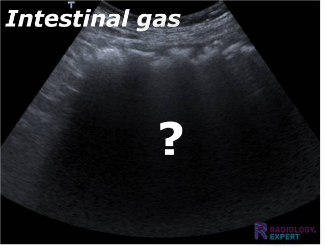Ultrasound Technique ultrasound-technique